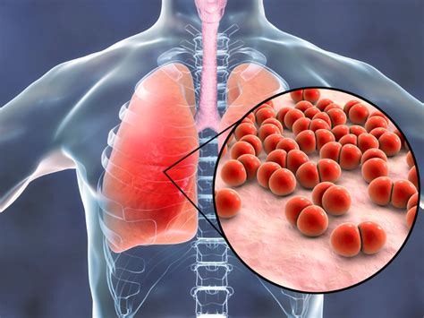 Entendendo a Pneumonia Associada à Ventilação Mecânica