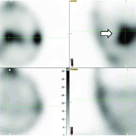 gallium scan initial upper row increased uptake  mastoid