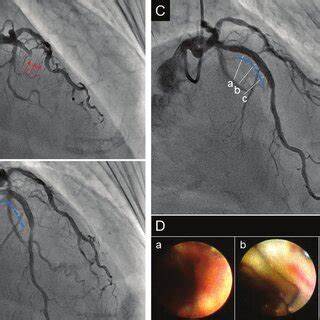 A Representative Case Of AMI With Platinum Chromium Everolimus Eluting