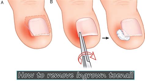 How To Remove Ingrown Toenail Nail Espicule Removal Step By Step Youtube