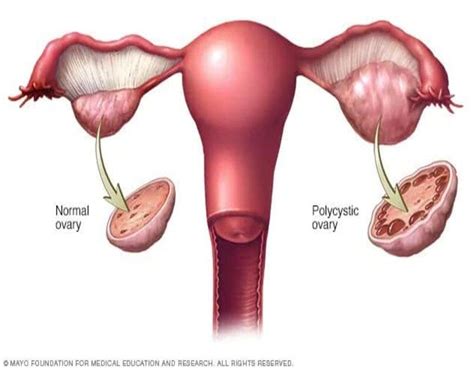 Uterine Fibroid Treatment In Thane With Dr Arohi Tasgaonkar By Dr