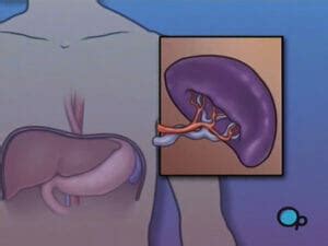 Spleen-Removal Laparoscopic Splenectomy • preop.com