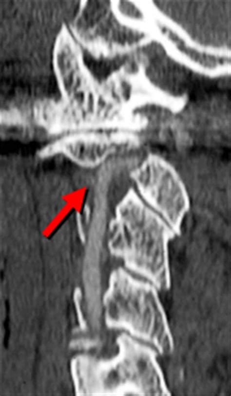 Odontoid Fracture Mri