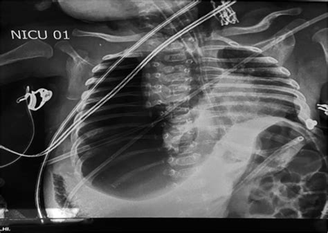 Diagnosing Pneumothorax With Bedside Ultrasound In A Neonate Post