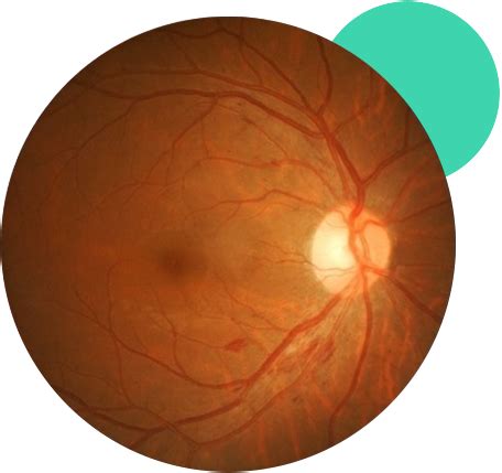 Retinopatía Diabética Clinica Oftaolmológica Visualiza