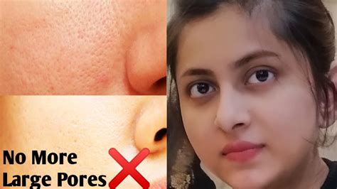 How To Get Rid Of Large Pores Permanently Get Rid Of Large Pores