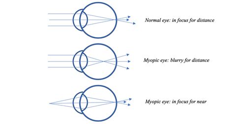 A Deeper Look At Short Sightedness