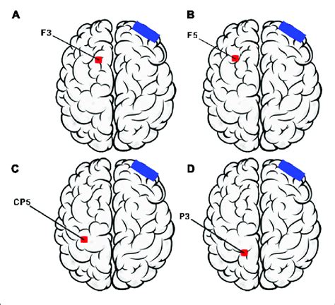 Dorsolateral Prefrontal Cortex Tdcs