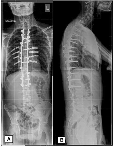 Whole Spine Postoperative Standing X Ray Images Showing The Download Scientific Diagram