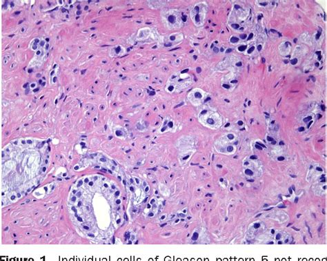 Gleason Pattern 5 Is Frequently Underdiagnosed On Prostate Needle Core