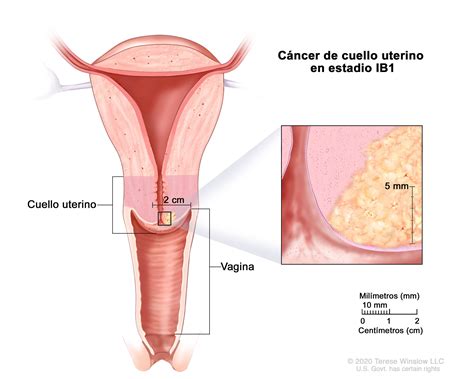 Definición De Cáncer De Cuello Uterino En Estadio I Diccionario De Cáncer Del Nci Nci