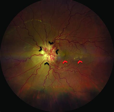 Fundus image of the patient's left eye at time of presentation showing ...