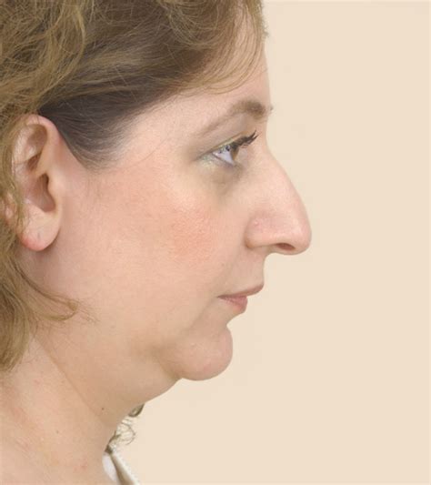 Cosmetic Nose Surgery : Rhinoplasty | Cleveland Clinic