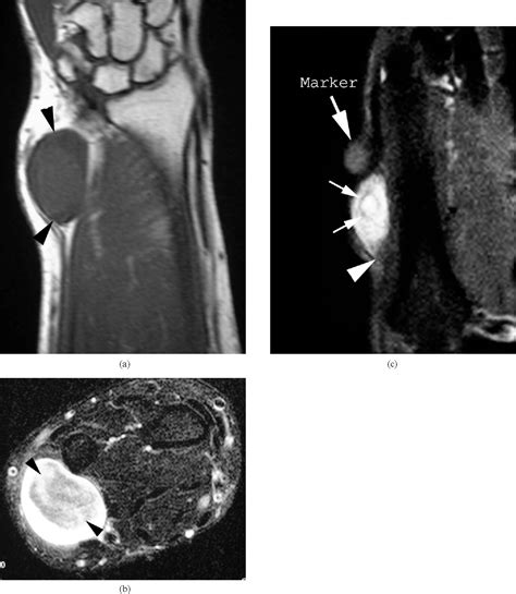 Figure From Mri Of Soft Tissue Masses Of The Hand And Wrist