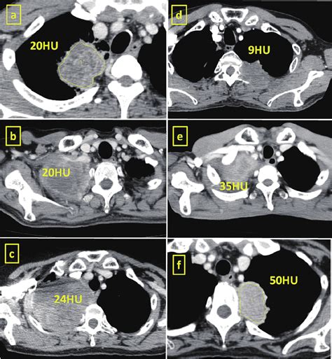 The Various CT Values HU Hounsfield Unit Of The Tumors On Dynamic