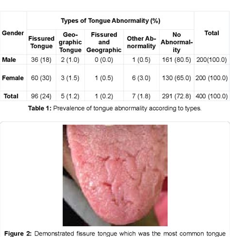 Figure 1 From Prevalence Of Fissured And Geographic Tongue