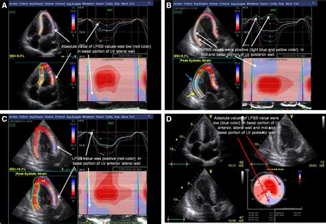 Efficiency Of Quantitative Longitudinal Peak Systolic Strain Values