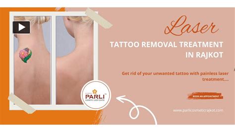 PPT Laser Tattoo Removal Treatment In Rajkot Best Doctor For