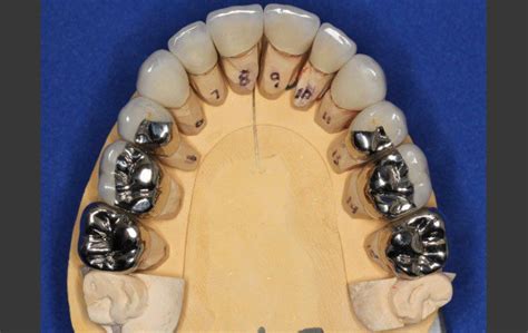 Severe Wear Abrasion Full Mouth Metal Porcelain Crowns Teeth Male