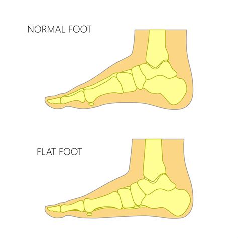 What are 'flat feet' in children and are they something to worry about?