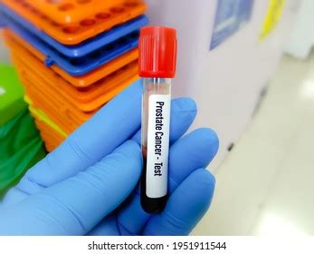 Blood Sample Psa Prostatespecific Antigen Test Stock Photo 1951911544