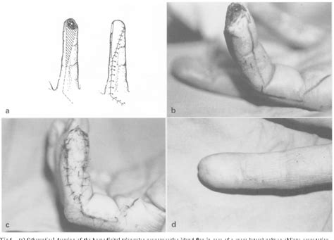 Figure 1 From Versatility Of The Homodigital Triangular Neurovascular Island Flap In Fingertip