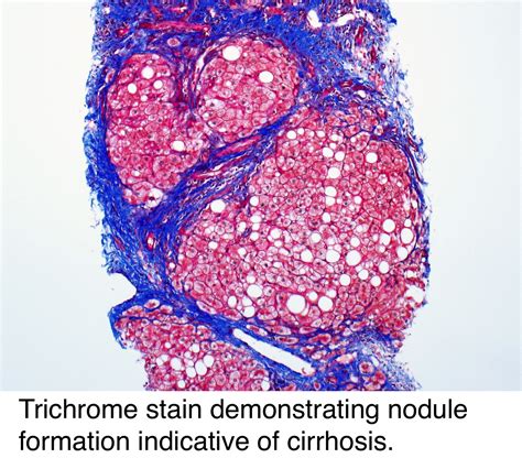 Pathology Outlines Chronic Hepatitis Grading Staging