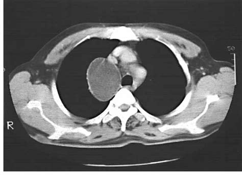 Figure 2 From Primary Hydatid Cysts Of The Mediastinum Semantic Scholar