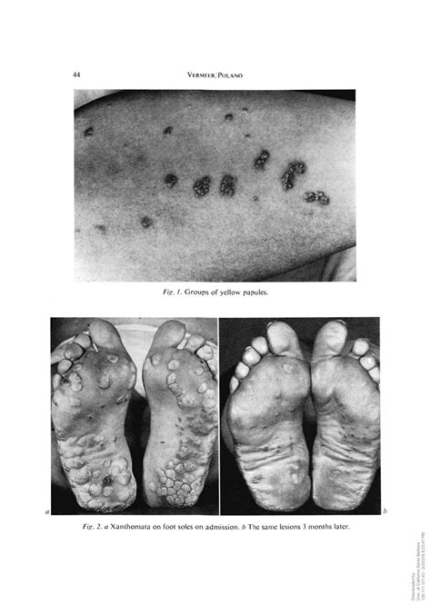 Solution A Case Of Xanthomatosis And Hyperlipoproteinemia Type V