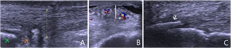 Ultrasonography And Doppler Guided Surgical Treatment For Insertional Achilles Tendinopathy