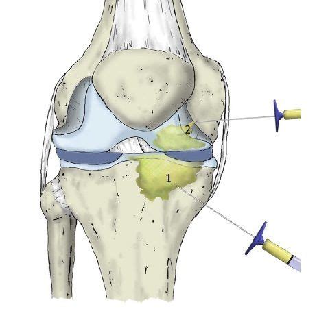 Plasma Rico En Plaquetas En La Rodilla Itramed