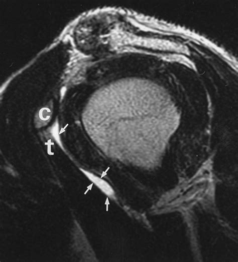 Subcoracoid Bursa