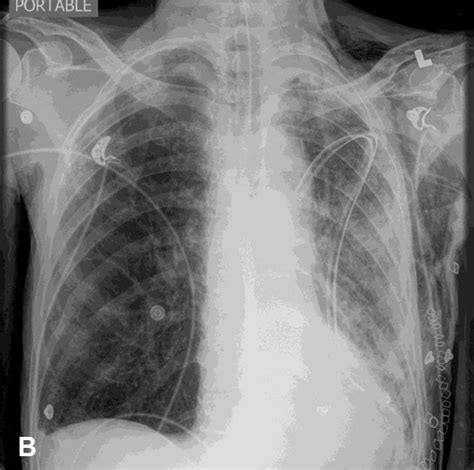 Chest Tube Placement X Ray