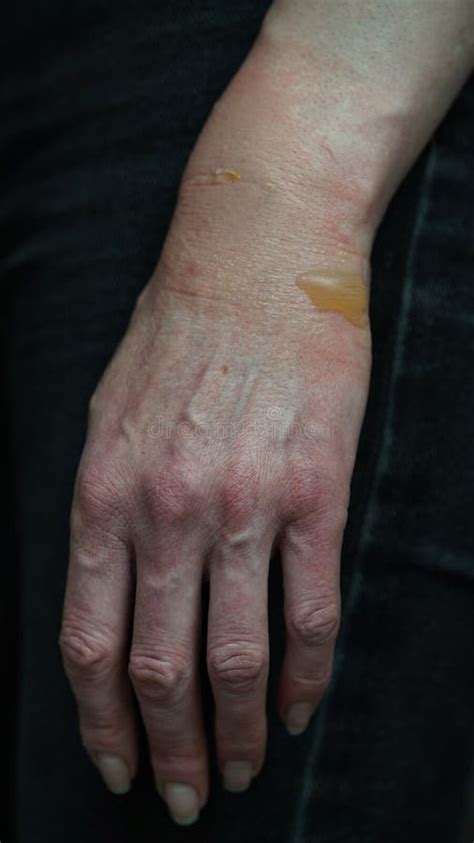 Close Up Of A Woman S Hand With A Blister From A Boiled Water Burn