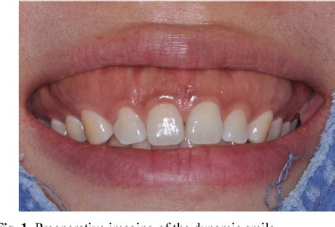 Figure 1 From Treatment Of Excessive Gingival Display Using Modified