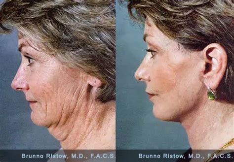 How To Tighten Skin Under Chin After Weight Loss - Detailed Look