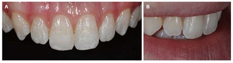 Enamel Microabrasion An Overview Of Clinical And Scientific