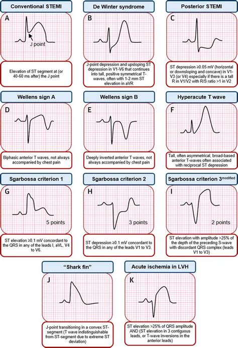 Detail Contoh Gambar Ekg Stemi Koleksi Nomer