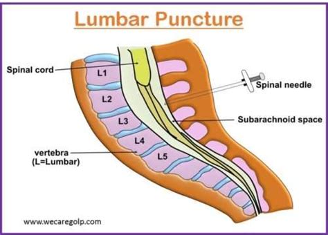 Lumbar Puncture Spinal Tap We Care