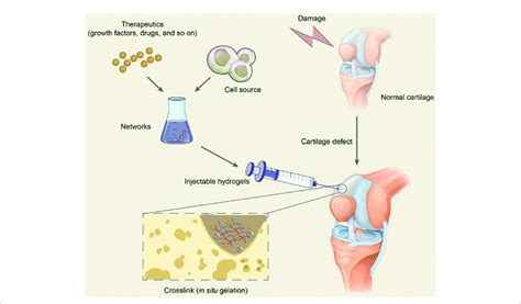 Schematic diagram of hydrogel injection in repairing cartilage defect.... | Download Scientific ...