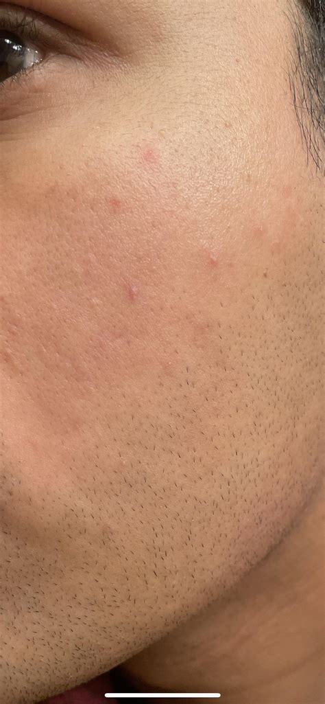 Finished Accutane A Week Ago But Getting These Tiny Pimples All Over My Face R Accutane