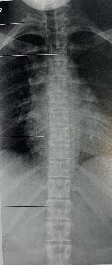 Ap Thoracic Diagram Quizlet