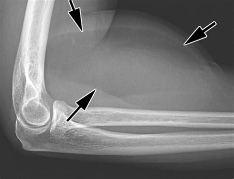 Soft Tissue Tumors And Tumorlike Lesions A Systematic Imaging Approach