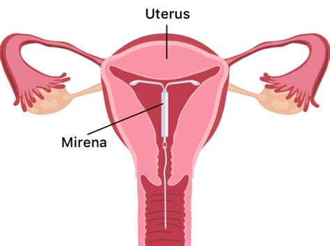 Mirena Iud Uses Pros And Cons Interactions And Cost