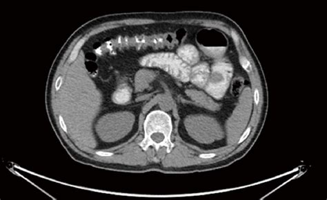 Figure 2 From Multiple Clear Cell Sarcomas Of Small Intestine With