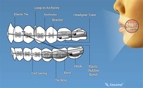 Braces Wire Size Chart