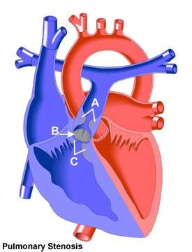 Stenosis: Infundibular Stenosis