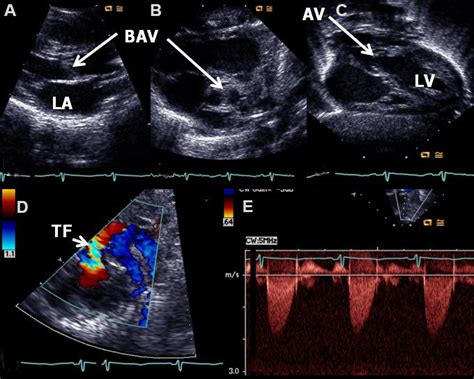 Echo Doppler Studies Illustrating A Thick A And Bicuspid B Aortic