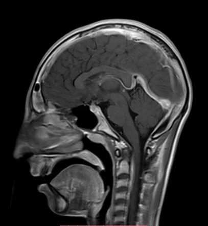 Normal Head Mr Angiogram Image Radiopaedia Org