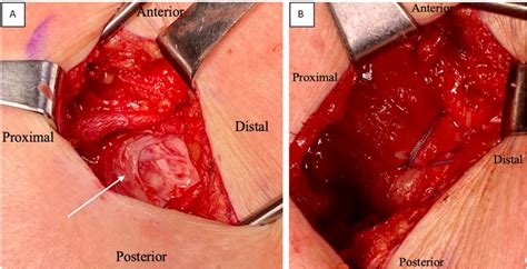 Figure 1 From A Review Of Abductor Tendon Tears Semantic Scholar